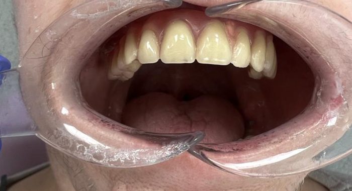 Dental-Implants-1---After-