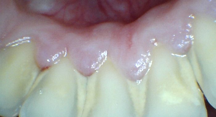 Teeth-Whitening-2---Before