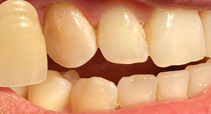 Teeth-Whitening-3