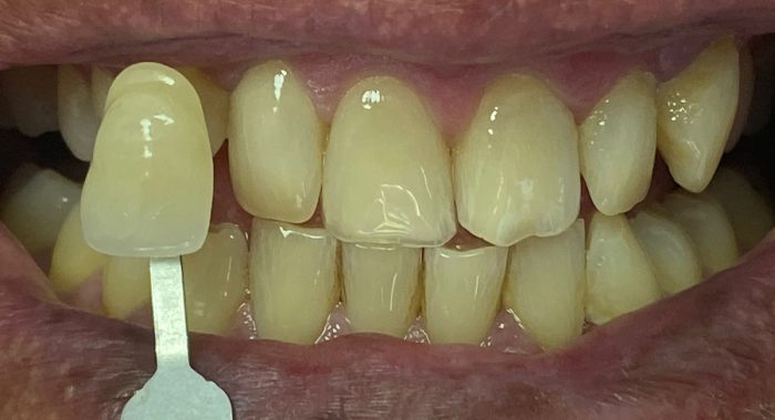 Teeth-Whitening-5